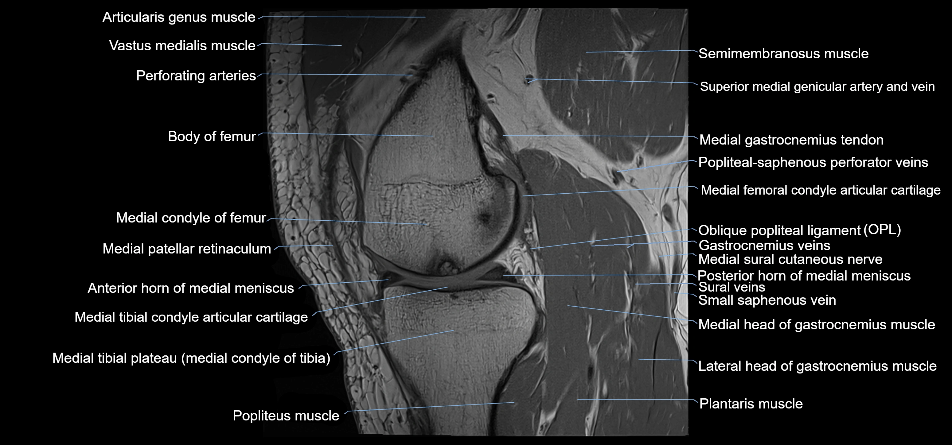 MRI knee sagittal cross sectional anatomy labelled 3T radiology image-00019.webp